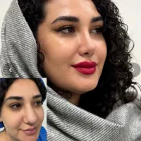 تخفیف 10 میلیونی عمل جراحی بینی