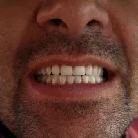 کشیدن دندان،دندانسازی،پروتزمتحرک باکمترین قیمت