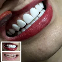 کامپوزیت زیبایی پالیش کامپوزیت لمینیت بلیچینگ|خدمات آرایشگری و زیبایی|تهران, تهرانپارس غربی|دیوار