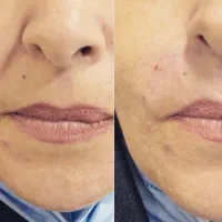 جشنواره ویژه تخفیفی تزریق ژل و بوتاکس و لیزر|خدمات آرایشگری و زیبایی|تهران, نیروی هوایی (پیروزی)|دیوار