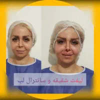 جشنواره پائیزی جراحی پلک.شقیقه.ابرو.سانترال لب.|خدمات آرایشگری و زیبایی|زاهدان, |دیوار