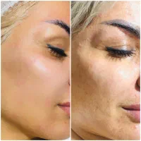 روشن سازی پوست و ریمو تتو تضمینی