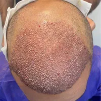 کاشت مو پر تراکم  تضمینی فقط 20 تومن|خدمات آرایشگری و زیبایی|رشت, بلوار گیلان|دیوار