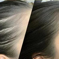 مدل خانم جهت انجام  میکرو اسکالپ کف سر