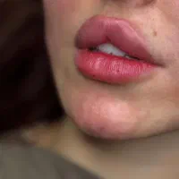 تزریق ژل و بوتاکس
