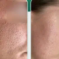 برداشتن خال وزگیل جوانسازی پاک کردن تاتو صورت وبدن|خدمات زیبایی و سلامت|کرمانشاه, |دیوار