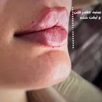 فیلر بادی(هیپ دیپ،بیکینی،ساق)محصولات سفیدکردن پوست|خدمات آرایشگری و زیبایی|بندر ماهشهر, |دیوار