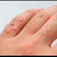 پماد دست ساز برداشتن خال گوشتی