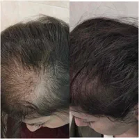 میکرو اسکالپ.اولین مرکز تخصصی میکرو اسکالپ در کرج|خدمات آرایشگری و زیبایی|کرج, عظیمیه|دیوار