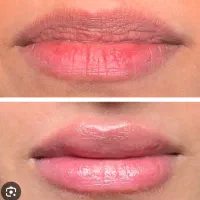 مزوتراپی &  PRP|خدمات آرایشگری و زیبایی|بندر انزلی, شاکوچه|دیوار