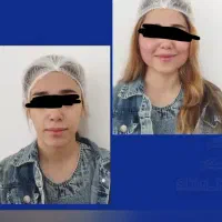 تزریق وتخلیه چربی جراحی پلک لابیا وغیره