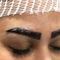 کاشت مو و ابرو و ریش و سیبیل اقساطی