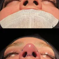 فرصت استثنایی وباورنکردنی عمل بینی بصورت اقساط|خدمات آرایشگری و زیبایی|ایذه, |دیوار