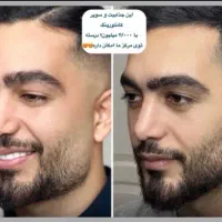 جشنواره ژل و بوتاکس توسط پزشک|خدمات آرایشگری و زیبایی|کرمانشاه, |دیوار