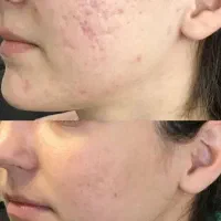 خال برداری کاملا بهداشتی وباوسایل یک بار مصرف|خدمات آرایشگری و زیبایی|قم, امامزاده ابراهیم|دیوار