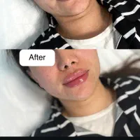 فیلر بوتاکس مزو پی ار پی توسط پزشک