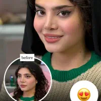 تزریق ژل و بوتاکس هایفو مزو پی ار پی از ۴۹۹