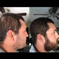 روش علمی کاهش ریزش و رویش مجدد مو