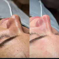 تخفیف به مدت یک هفته(پاکسازی پوست،اپلاسیون،لیفت)