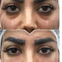 تخفیف ویژه شهریور ماه تزریق مزوژل-فیلر-بوتاکس