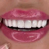 کامپوزیت انجام با متخصصین فک و صورت