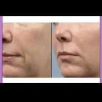 بوتاکس ۸۵۰مصپورت و ژل ۱۸۰۰ توست پزشک انجام میشه|خدمات آرایشگری و زیبایی|مشهد, محمدآباد|دیوار