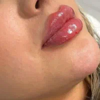 مدل تزریق ژل