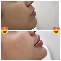 ژل و بوتاکس 650(آموزش)