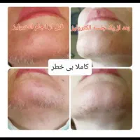 الکترولیز روشی قطعی حذف موهای زائد صورت|خدمات آرایشگری و زیبایی|اشنویه, |دیوار