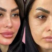 مرکز تخصصی جوانسازی اندولیفت/انواع هایفو/لیفت ۸۵۰ت|خدمات آرایشگری و زیبایی|اصفهان, احمدآباد|دیوار