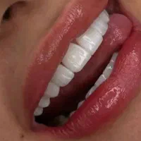عصب کشی ۱۴۰۰/کامپوزیت ۵/روکش ۴/لمینت۷/ایمپلنت