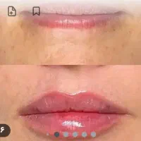 انجام تمام خدمات فیلر|خدمات آرایشگری و زیبایی|شهرکرد, |دیوار