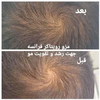 لیزر موهای زائد بانوان آقایان ژل بوتاکس/جنت اباد|خدمات آرایشگری و زیبایی|تهران, جنت‌آباد جنوبی|دیوار