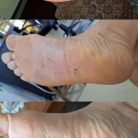 ترک پا،میخچه، اگزما|آرایشی، بهداشتی، درمانی|قروه, |دیوار