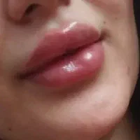 ژل ـ لب ـ گونه و... بوتاکس. آنزیم|خدمات آرایشگری و زیبایی|قم, تولید دارو و یخچال|دیوار