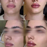 جشنواره ژل و بوتاکس با قیمت باورنکردنی/اقساط|خدمات آرایشگری و زیبایی|آمل, |دیوار