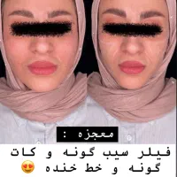 بوتاکس مصپورت۵۹۹ژل مجوزدار ۱/۲۰۰مادلینگ۵/۹۹۹|خدمات آرایشگری و زیبایی|قم, حاج زینل|دیوار