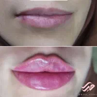 فیلرلب روسی ،گونه و زاویه،بوتاکس، فول فیس،زیرچشم|خدمات آرایشگری و زیبایی|شیراز, ستارخان|دیوار