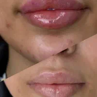 تزریق فیلر و بوتاکس و آنزیم با بهترین کیفیت|خدمات آرایشگری و زیبایی|قم, صدوق|دیوار
