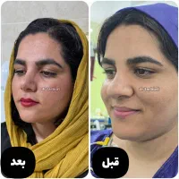 جراحی زیبایی بینی و صورت با بخیه جذبی