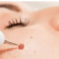 کلینیک ویژه برداشت خال، زگیل، میخچه