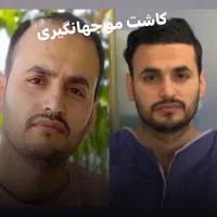 کاشت مو تضمینی