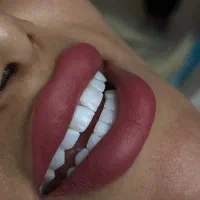 کامپوزیت فکی ۳/۹۰۰ به مدت یک هفته