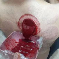 حجامت .فصد.زالودرمانی.برداشتن خال وزگیل|خدمات آرایشگری و زیبایی|بومهن, |دیوار