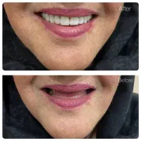 ساخت و تعمیر دندان مصنوعی/مواد آلمانی/نقد و اقساط|خدمات آرایشگری و زیبایی|چناران, |دیوار