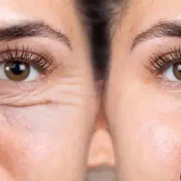 رفع لک‌ها وچروک صورت