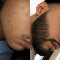 رویش ریش و سبیل کمتر از یکماه