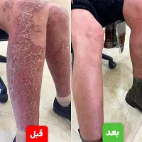 درمان دائمی بیماری پیسی وپسوریازیس واگزما|خدمات آرایشگری و زیبایی|امیدیه, |دیوار