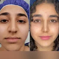 آفر ویژه عمل بینی /پلک /دندان/لیپوساکشن/غبغب|خدمات آرایشگری و زیبایی|شیراز, عفیف‌آباد|دیوار
