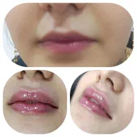 تزریق فیلر به ناحیه لب چانه گونه خط لبخند